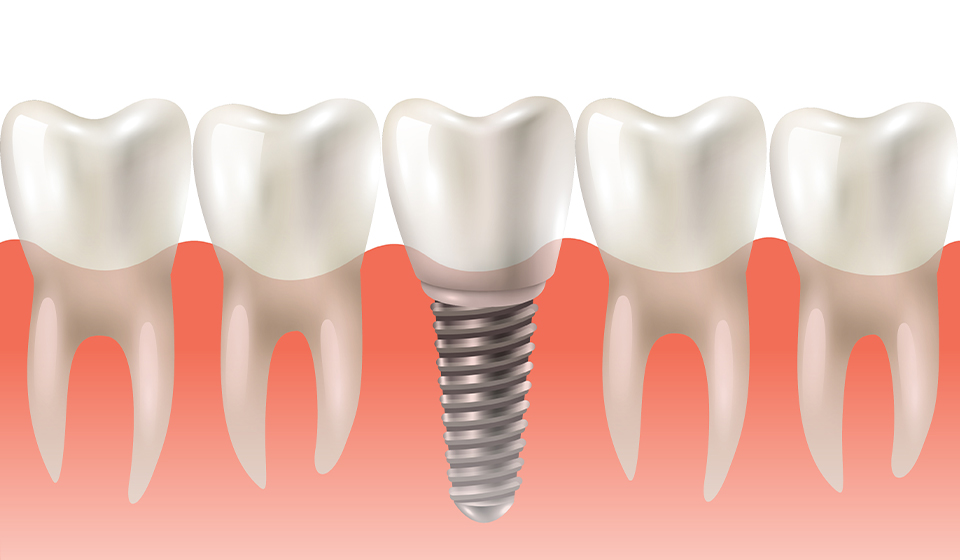 Replace Your Missing Tooth With Dental Implants