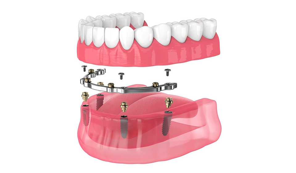 All-on-4 Implants For a Smile Transformation