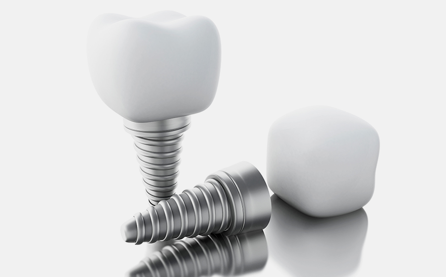4 Reasons Patients Choose Dental Implants