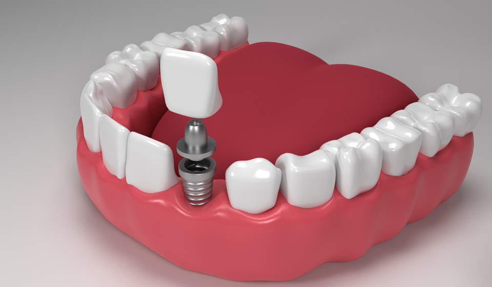 What are the Same Day Dental Implants? Types, Procedures, and More