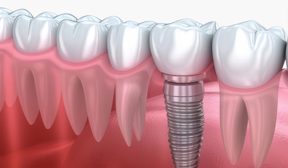 Understanding Same Day Dental Implants: Procedures, Types, and Benefits