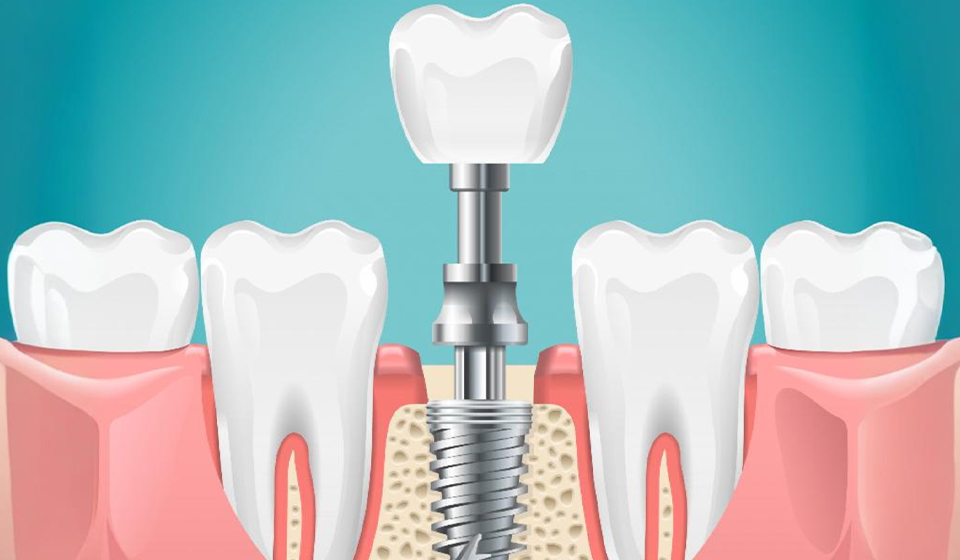 How to Care for Your Dental Implants: Tips for Long-Lasting Success