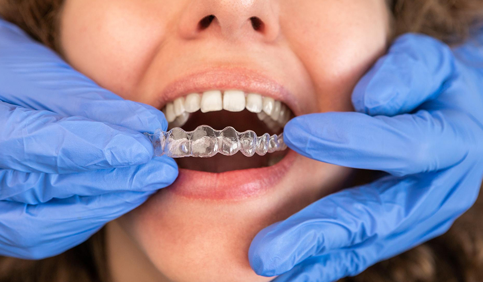 How Invisalign Helps with Crowded Teeth and Spacing Issues