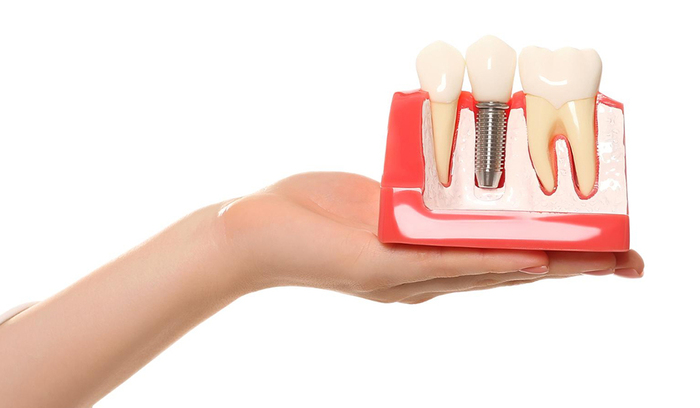 5 Key Benefits of Dental Implants for a Healthier Smile