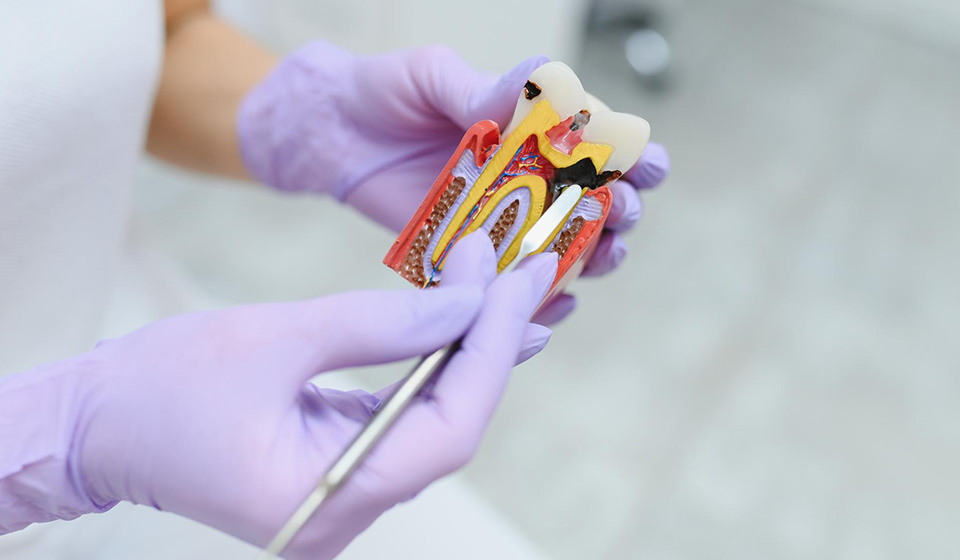 The Step-by-Step Process of Root Canal Treatment Explained