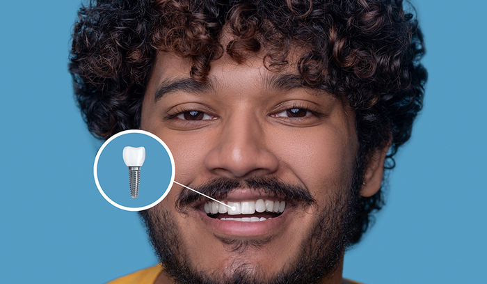 The Step-by-Step Process of Getting Dental Implants Explained