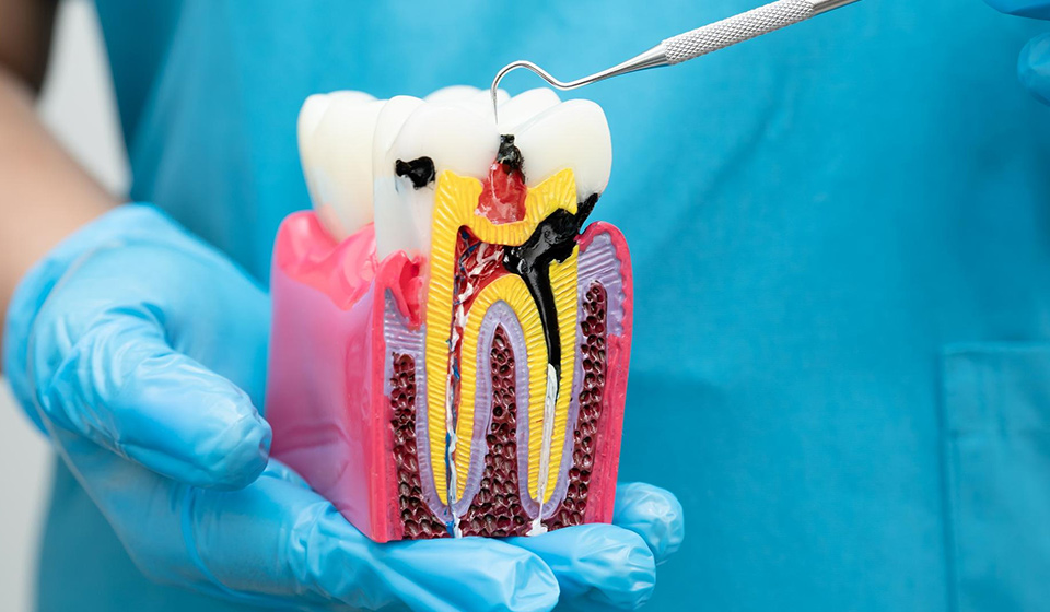 What Happens If You Avoid Root Canal Treatment?
