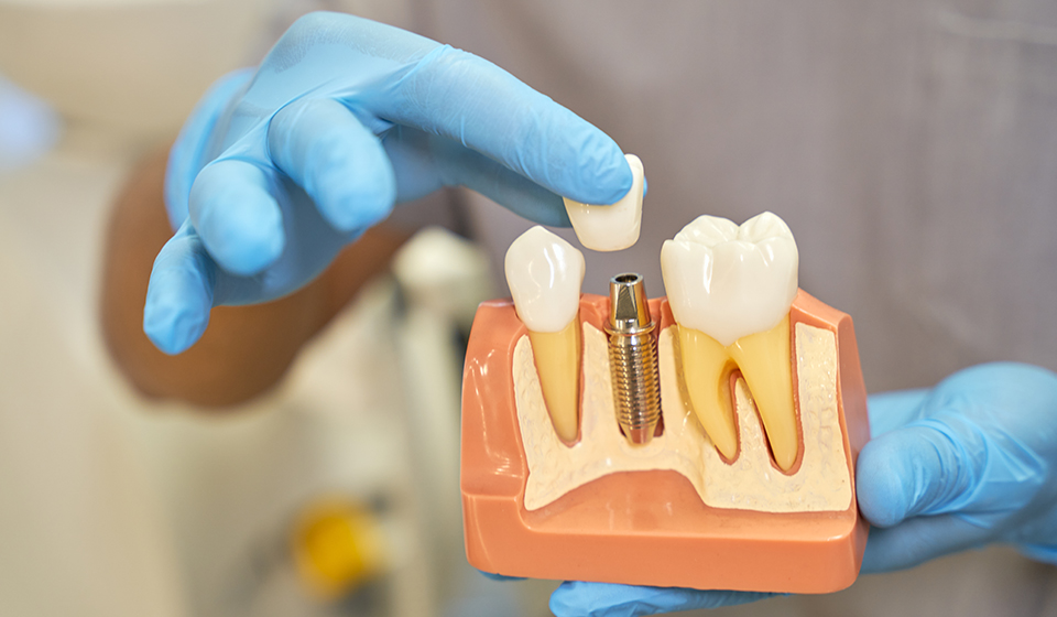 What Are Dental Implants and How Do They Work?