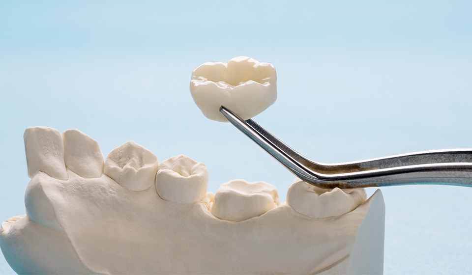 Step-by-Step Guide to the Dental Crown Process