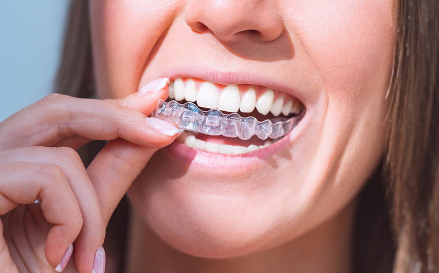 What Should You Know Before Starting Invisalign Treatment