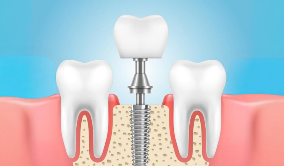 How to Care for Your Dental Implants After Surgery