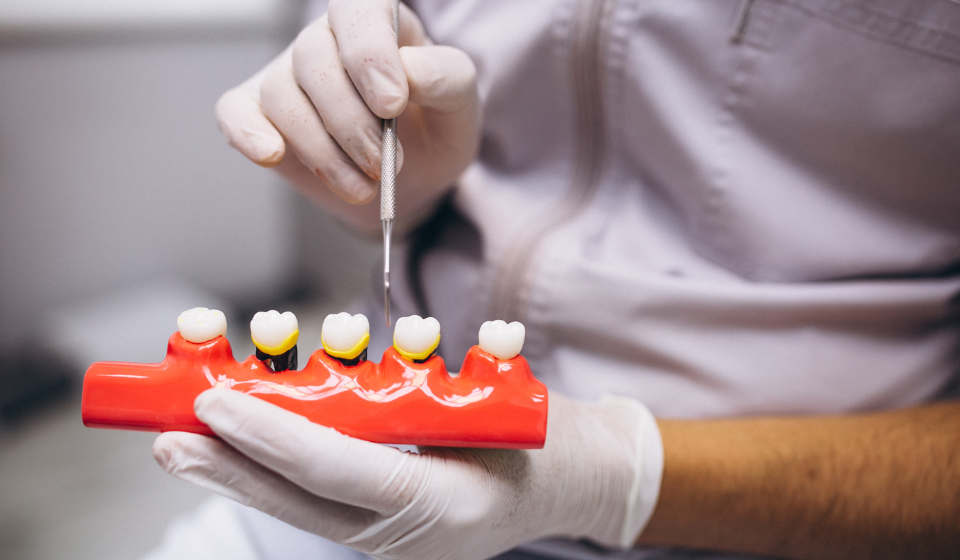 Benefits of Dental Implants for Smile Restoration