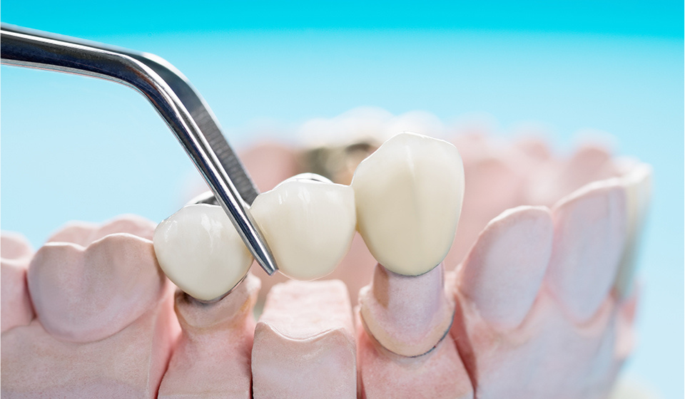 Why Dental Crowns Are Important for Tooth Restoration