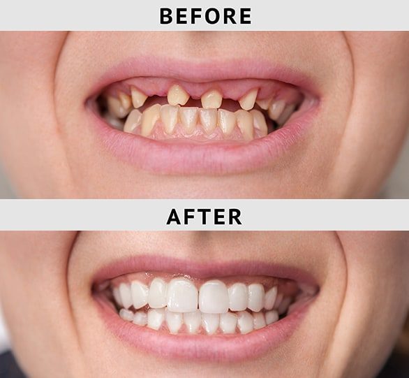 Permanent Dental Implants In NYC | Modern Dental Of Manhattan