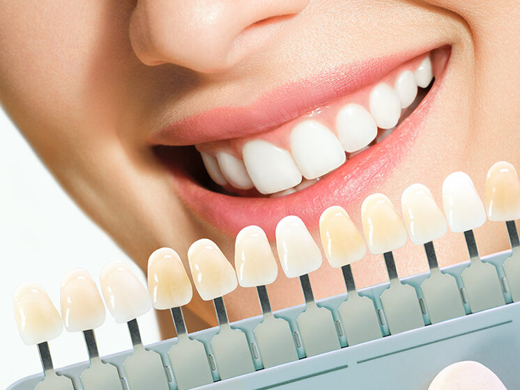 Porcelain Veneers