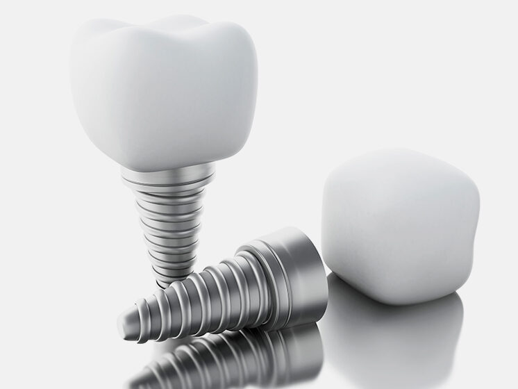 Dental Implants in New York