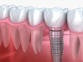 same day dental implants