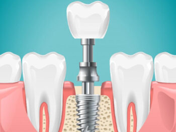 dental implants in New York