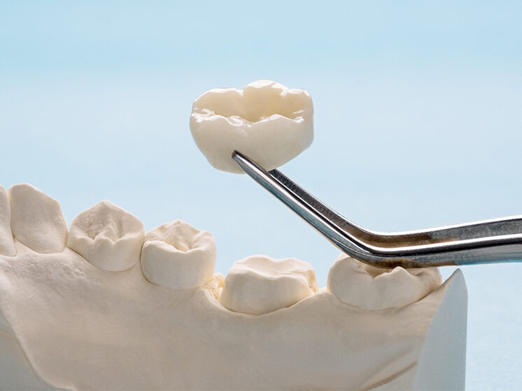 Dental Crown Process