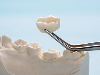 Dental Crown Process