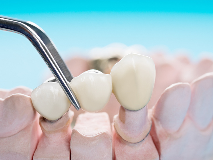 Dental Crowns