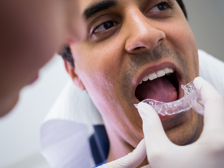 Clear Aligners