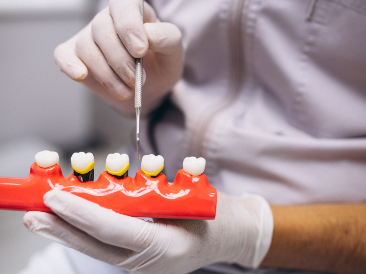 Dental Implants