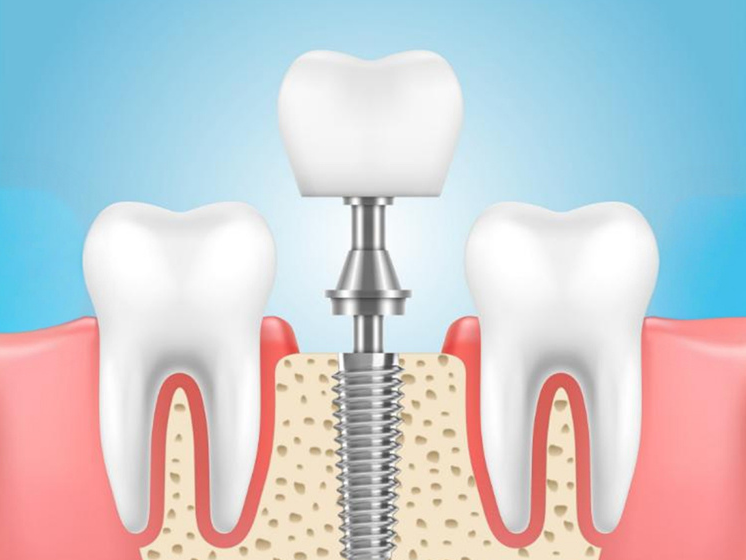 Dental Implants