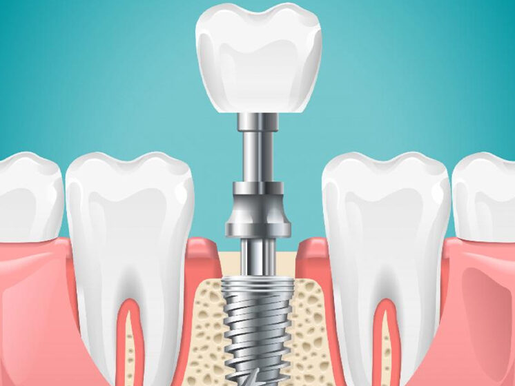 How to Care for Your Dental Implants