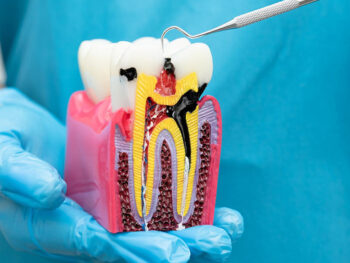Root Canal