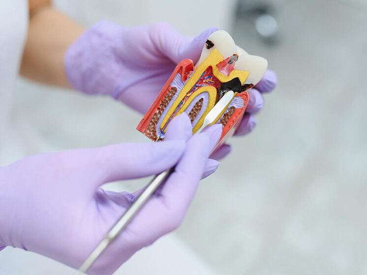 Root Canal Treatment Manhattan